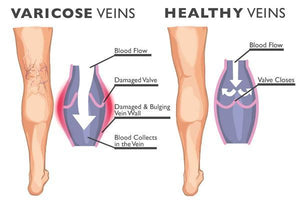 Varicose Veins Treatment Cream - ZUNARIS