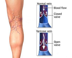 Varicose Veins Treatment Cream - ZUNARIS